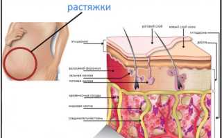 Сложности появления растяжек на теле в подростковом возрасте