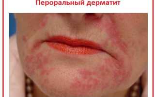 Аллергические высыпания на подбородке у женщин причины. По каким причинам чешется подбородок