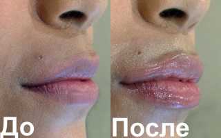 Что нужно знать, впервые делая ботокс в 20+, 30+ и 40+